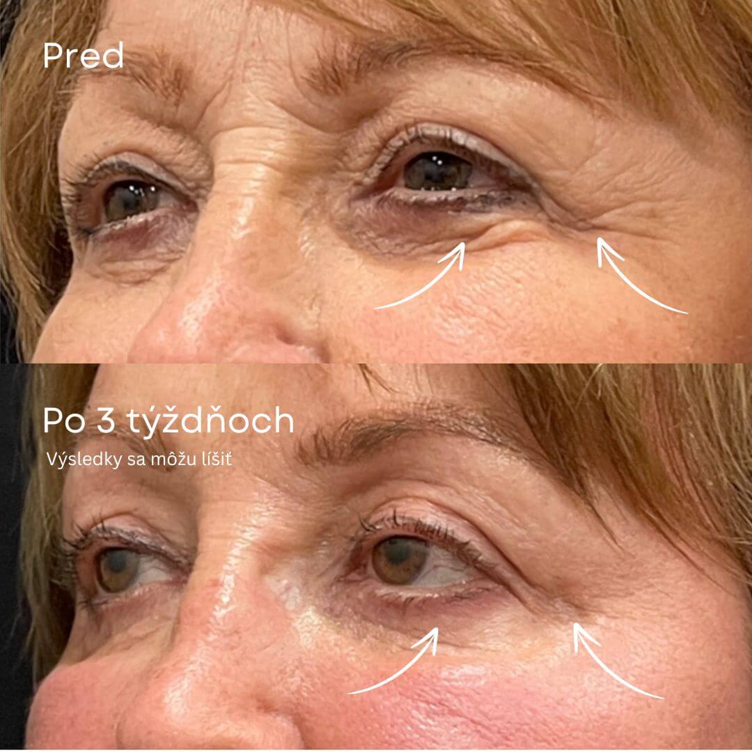 GlowLift Retinolový Očný Stick